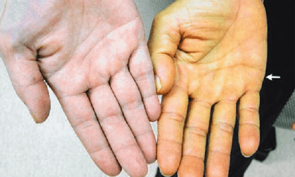 Siêu âm phát hiện nhiều người trẻ gan thô xù xì, nguyên nhân vì đâu?