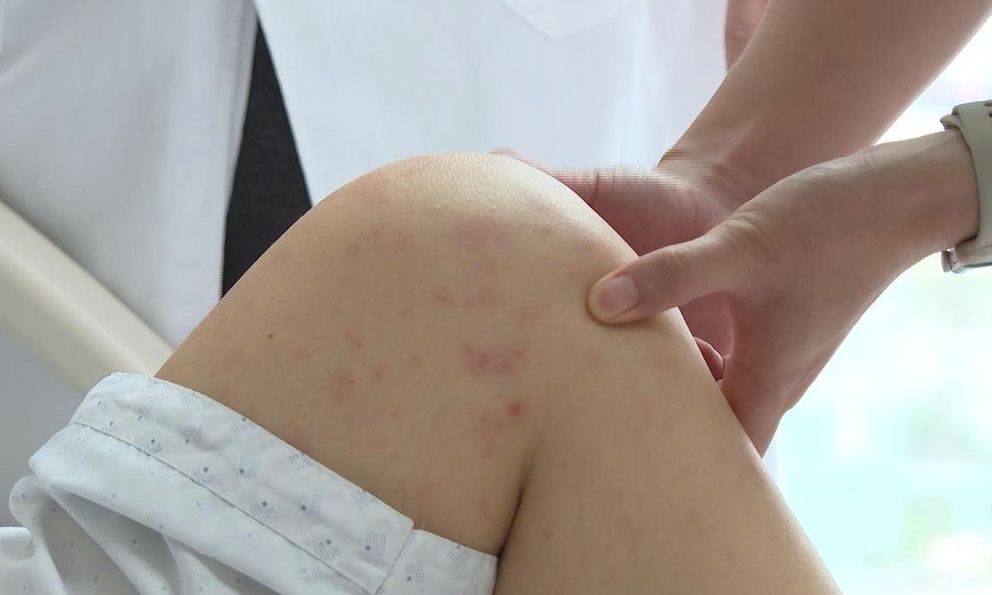 Hà Nội: Cô giáo mầm non viêm phổi do mắc thủy đậu, sai lầm vì 