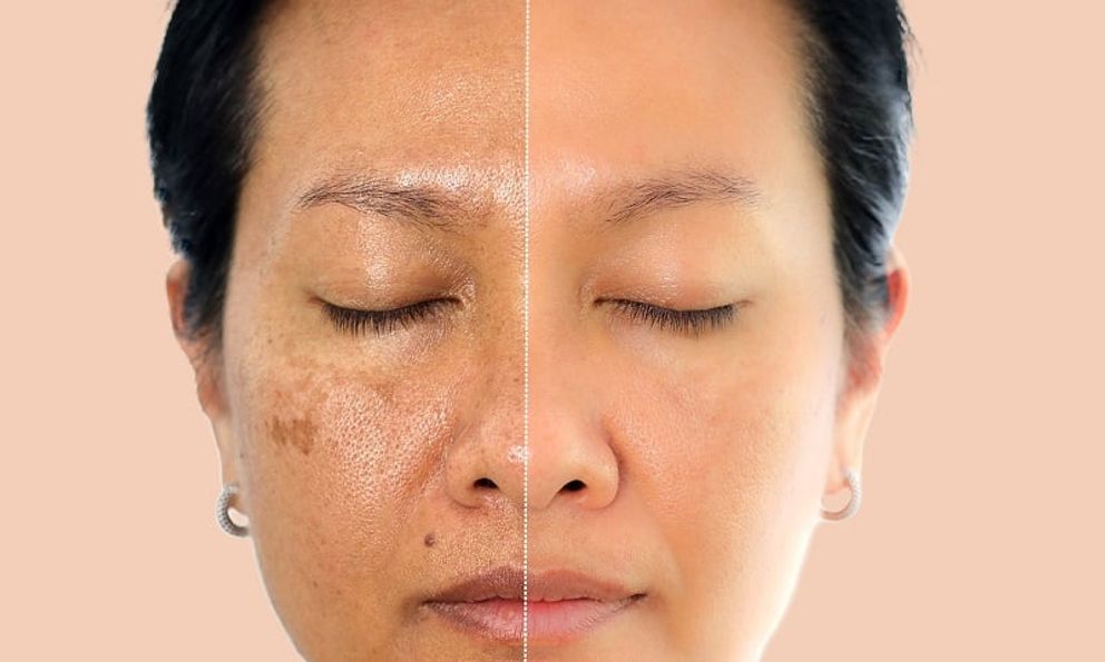 Oxy cao áp: Khi nào dùng để làm đẹp, chống lão hóa và kiểm soát bệnh chuyển hóa?