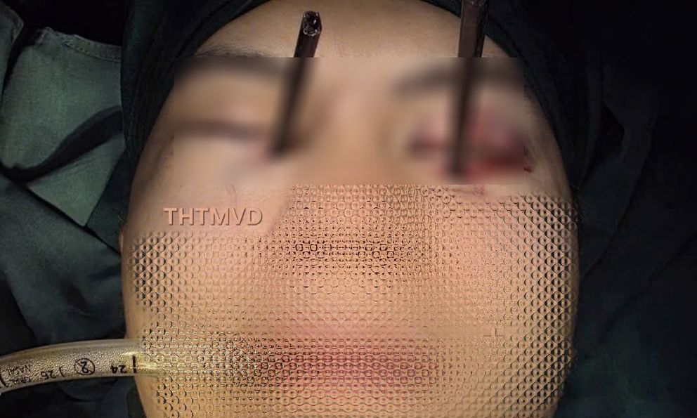 Hy hữu: Nam thanh niên 25 tuổi bị 2 chiếc đũa đâm thẳng vào 2 mắt cùng lúc