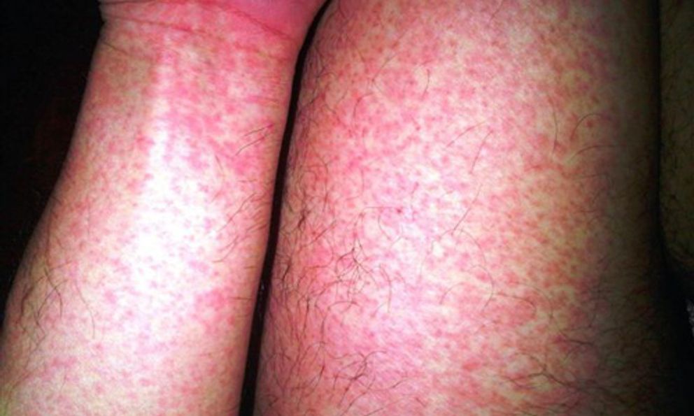 Gần 32.000 ca mắc, 4 ca tử vong: Bệnh viện Bạch Mai phát cảnh báo về 1 căn bệnh đang tăng nhanh, có thể suy đa tạng chỉ trong vài ngày