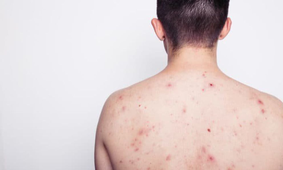 Nam thanh niên 23 tuổi nhiễm HIV sau khi tham gia lễ hội té nước tại Thái Lan