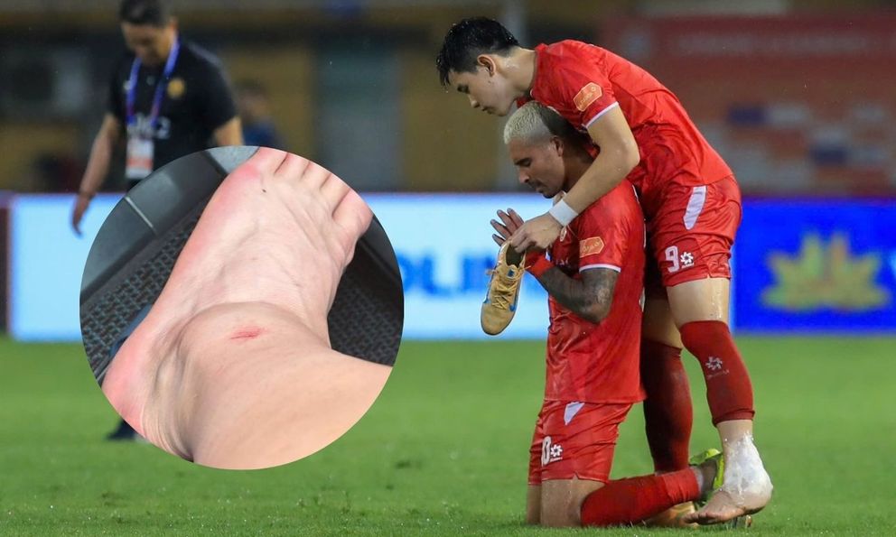 Đình Bắc lộ ảnh cổ chân sưng biến dạng sau trận vô địch V.League cùng CLB CAHN