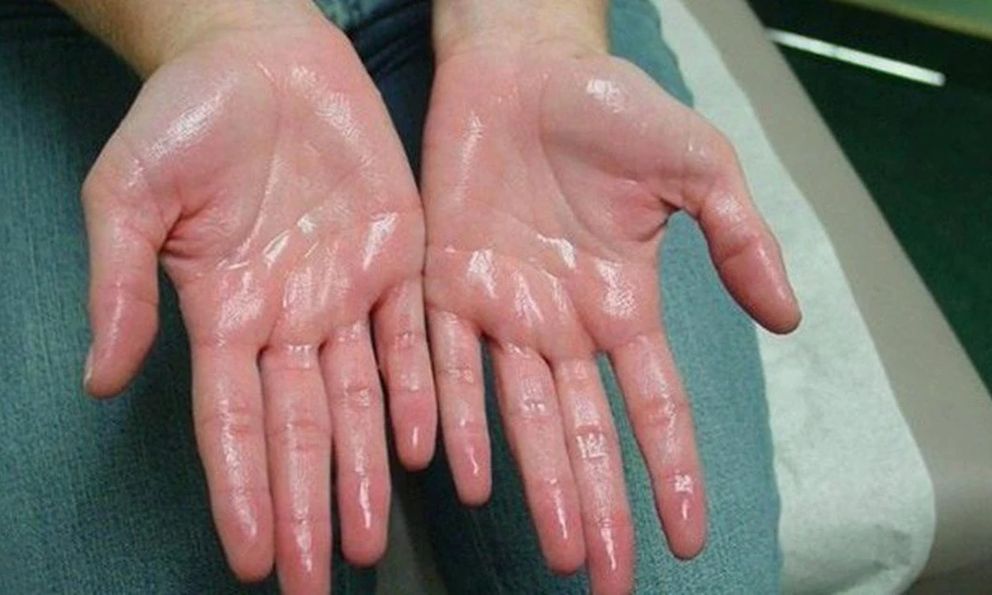 Khuyên thật: Thấy 5 thứ trên bàn tay phải đi khám thận ngay! 