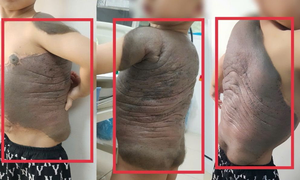 Bé trai Hà Nội mang khối u khổng lồ như 