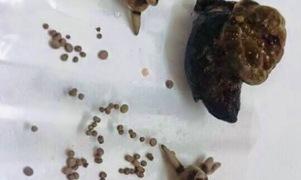 Bệnh sỏi thận: Vì sao trong cùng 1 quả thận lại có các viên sỏi khác nhau và chia sẻ của bác sĩ 