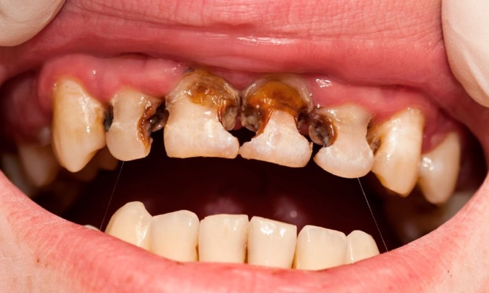 Trẻ thiếu canxi thường phát ra 5 tín hiệu: Bệnh viện Nhi đồng 2 cảnh báo đừng chủ quan