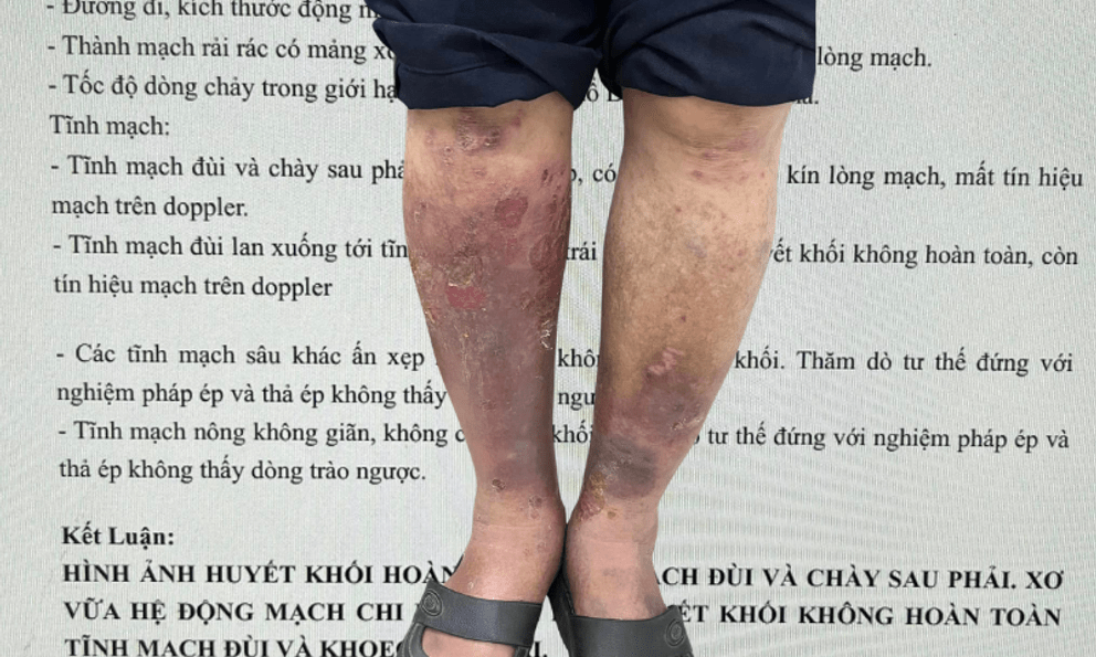 Bác sĩ chuyên ngành mạch máu xót xa khi bệnh nhân biến chứng suy giãn tĩnh mạch chi dưới, nguy cơ huyết khối, tử vong vẫn: 