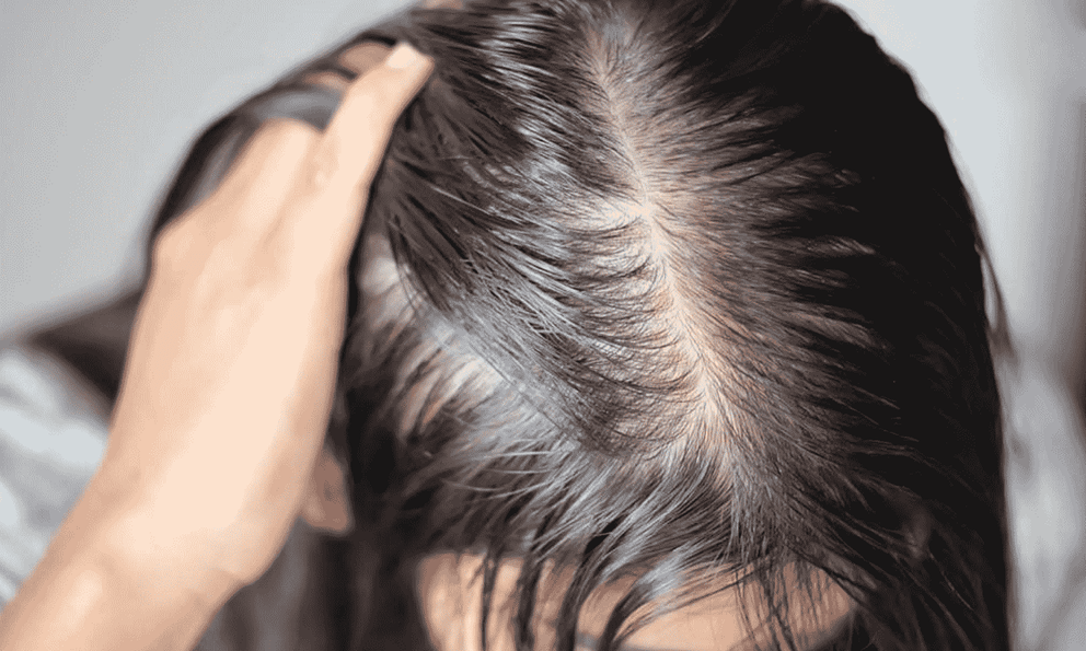 Tưởng stress vì thi cử nên rụng tóc, cô gái 22 tuổi phát hiện căn bệnh đang âm thầm đang phá hủy thận