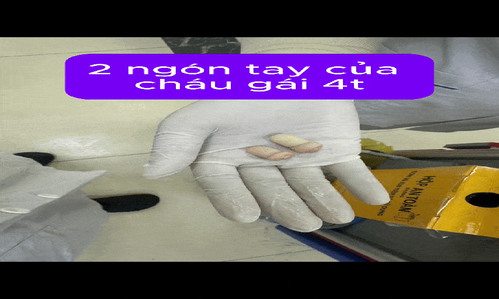 Bác sĩ Xanh Pôn ám ảnh ca bệnh đứt rời 2 ngón tay do máy dập nắp cốc trà sữa: 