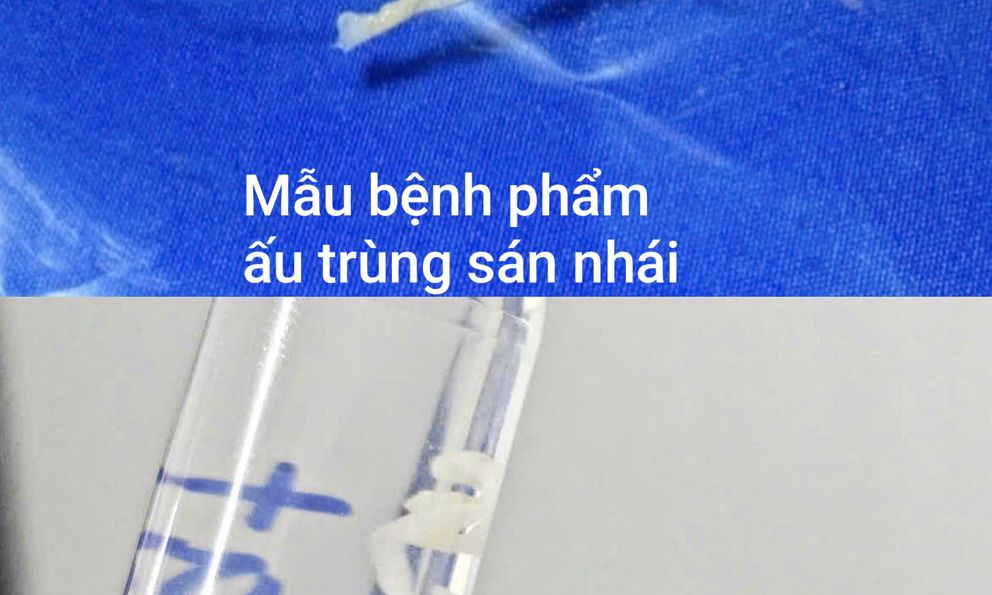 Phát hiện sán dài 7cm trong cơ thể người đàn ông 40 tuổi ở Hà Nội, không ăn đồ tái sống