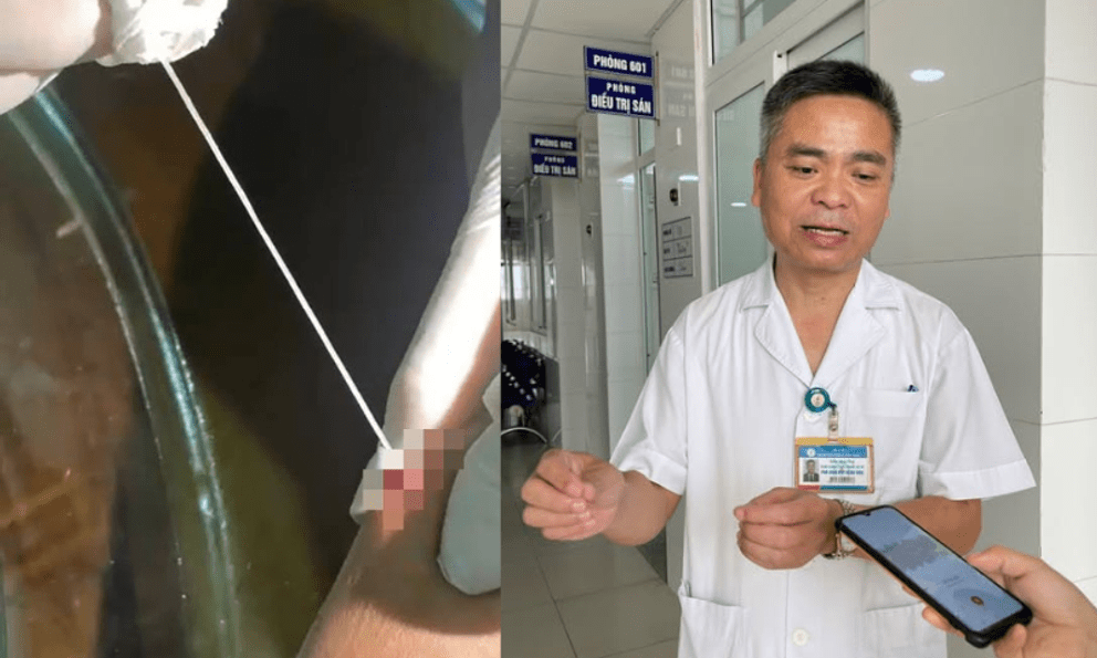 Phát hiện ca giun rồng thứ 44 tại Việt Nam: Người đàn ông ở Lào Cai có vết 