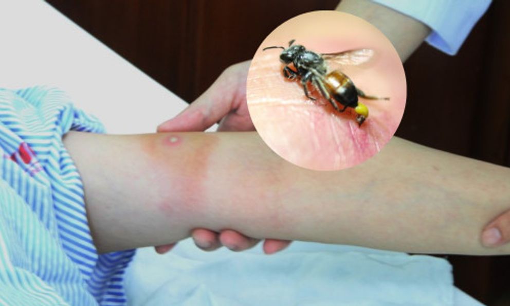 Bị ong đốt đừng vội hoảng: 7 thứ có sẵn trong nhà có thể giúp giảm sưng đau nhanh chóng, thứ đầu tiên hầu như ai cũng có