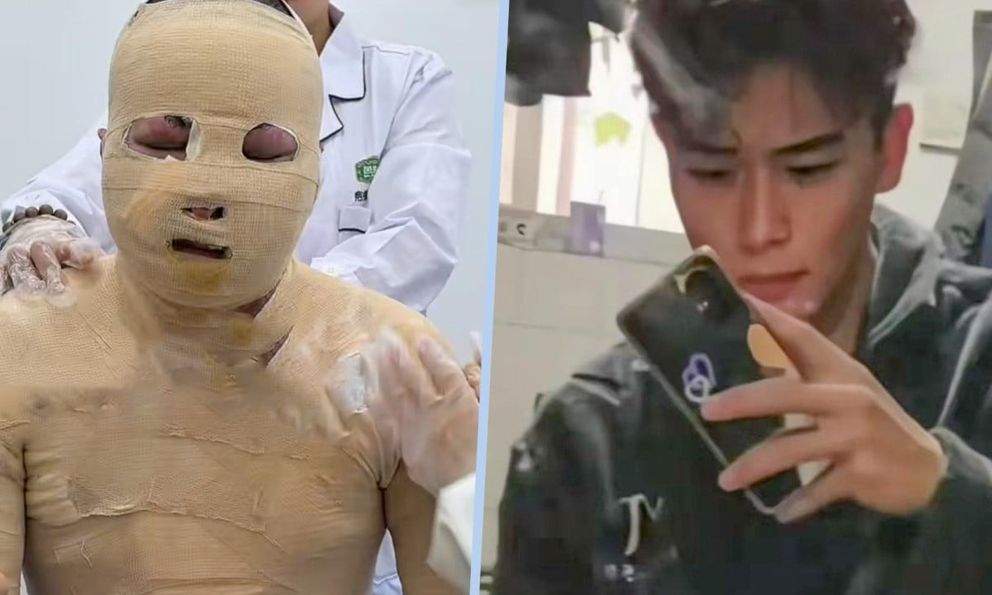 Chàng trai khôi ngô bị bỏng 90% do xe đạp điện Trung Quốc nổ khi sạc, bạn cùng phòng có hành động phẫn nộ