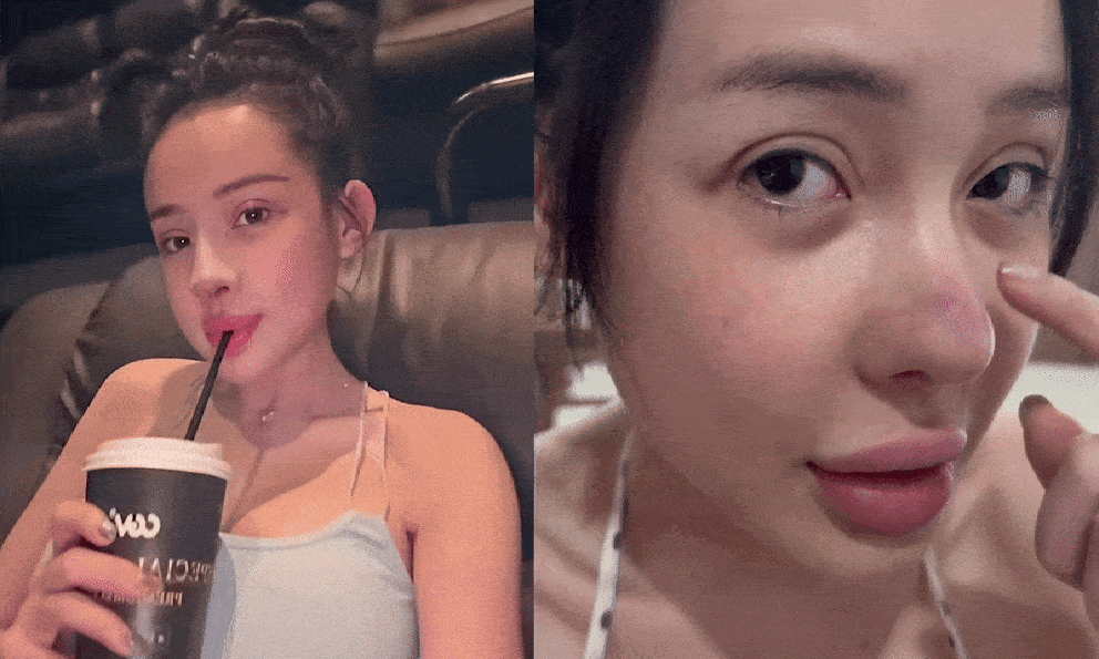 Ngân 98 bị biến chứng nhiễm trùng nặng sau 11 lần phẫu thuật thẩm mỹ